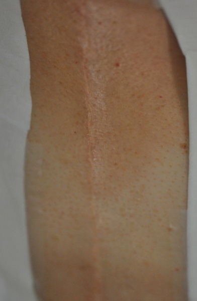 Scar camouflaging before treatment